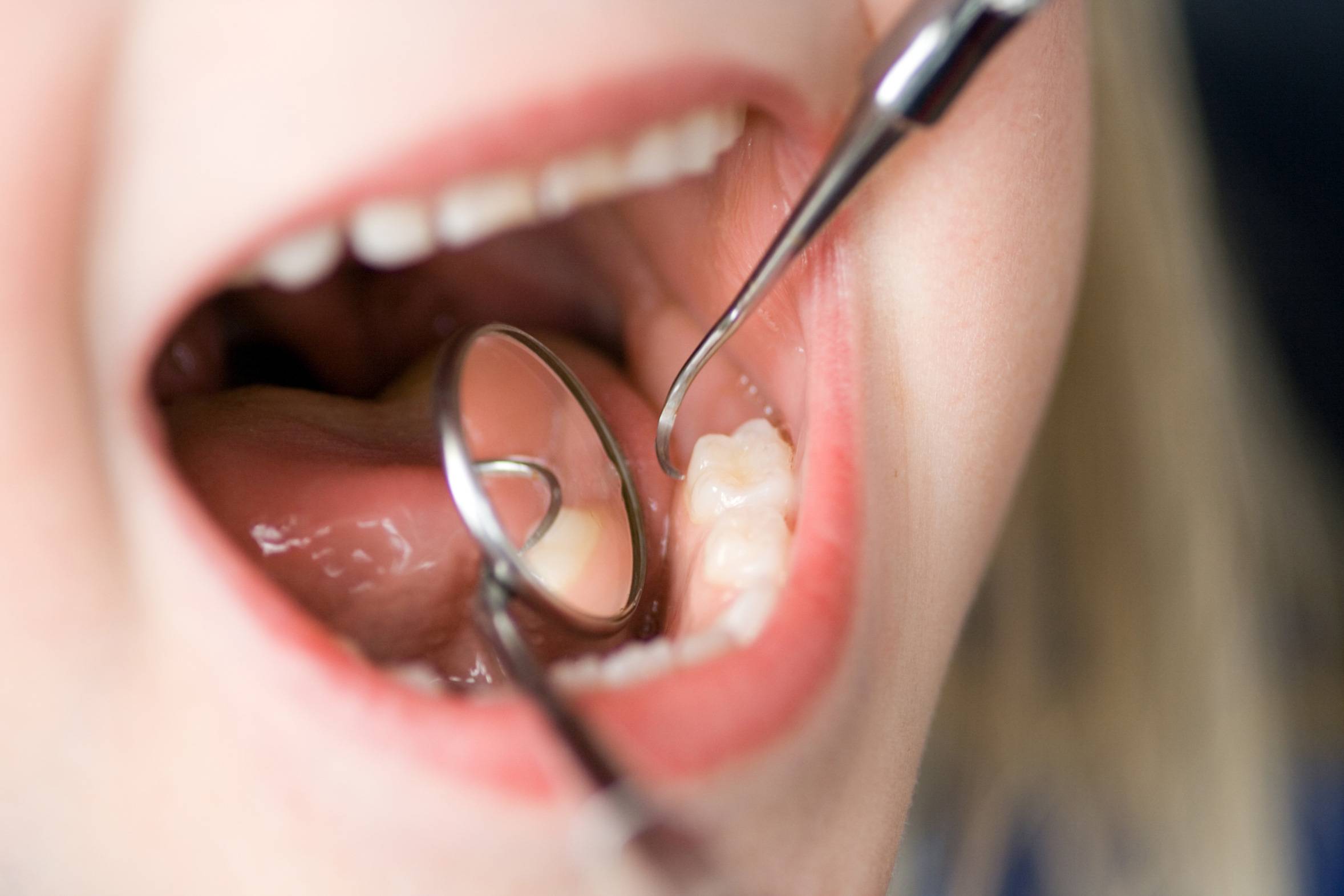 عواقب پوسیدگی دندان
