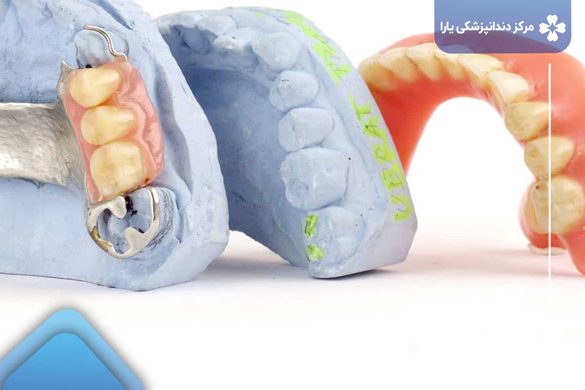 جایگزینی برای دندان مصنوعی در تهران پارس: