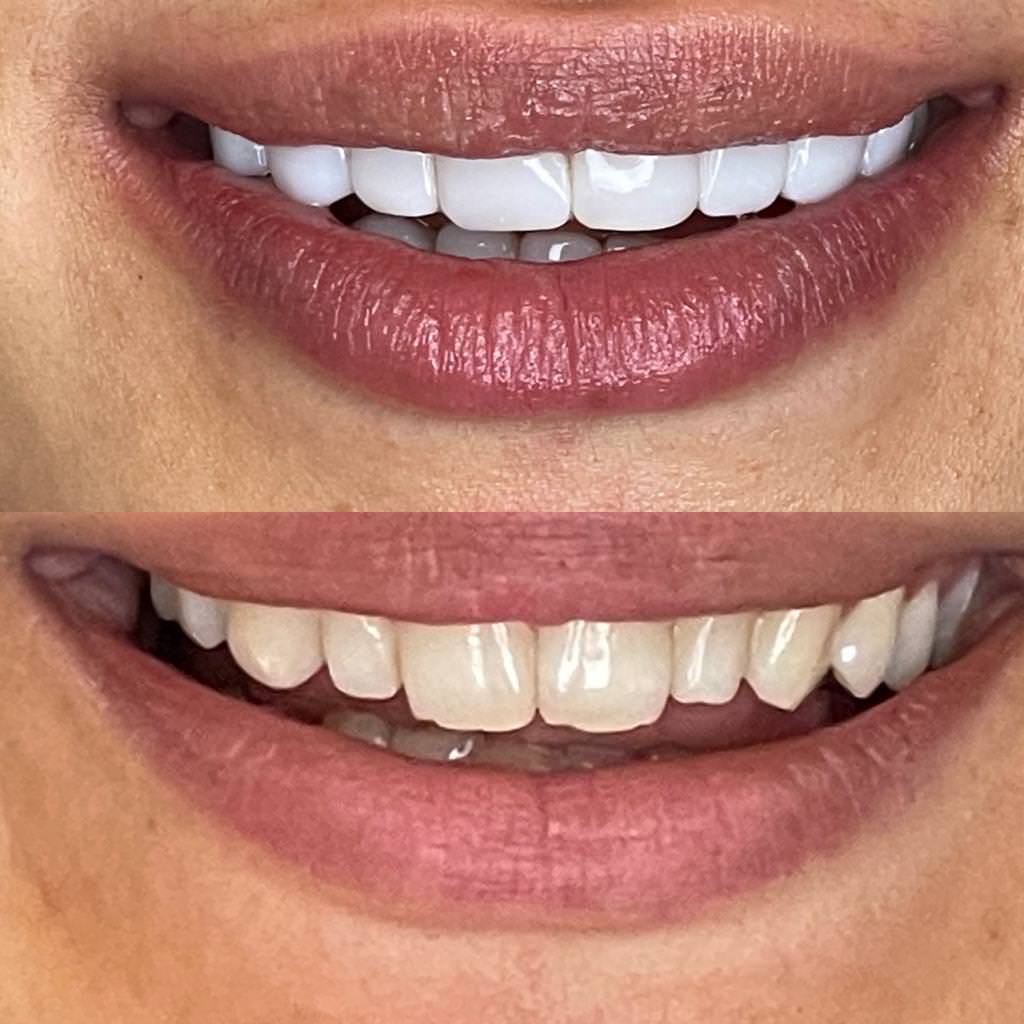 قبل و بعد لمینت دندان در کلینیک دندانپزشکی در تهرانپارس
