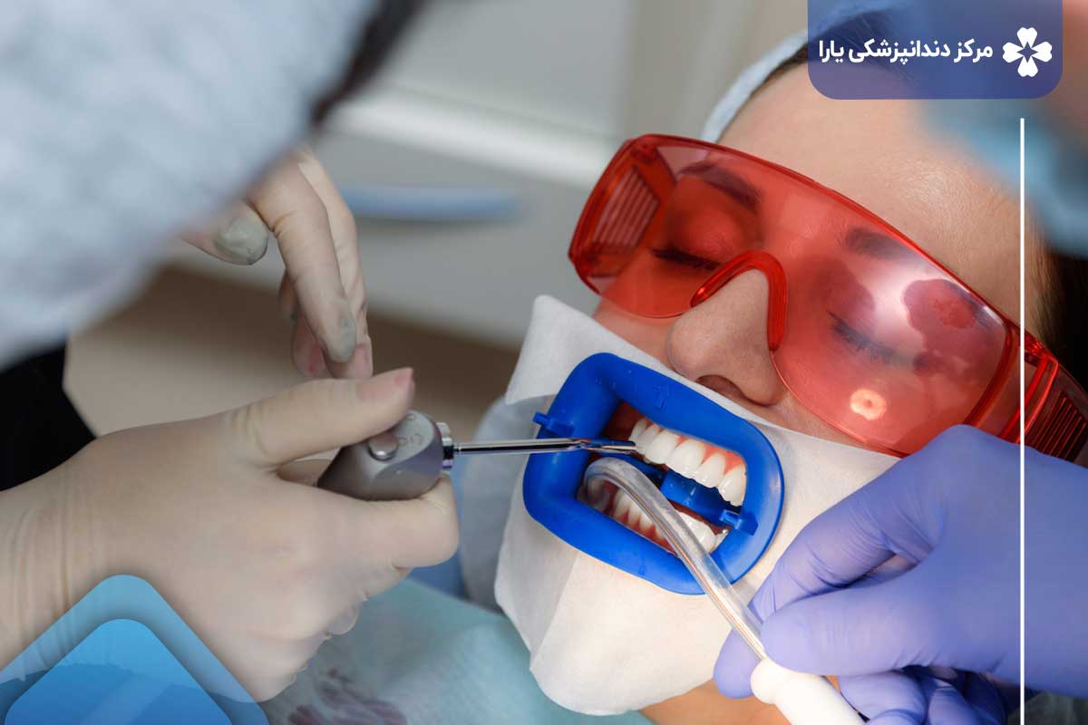 بلیچینگ دندان در تهرانپارس چگونه رنگ دندان‌ها تغییر می‌دهد؟