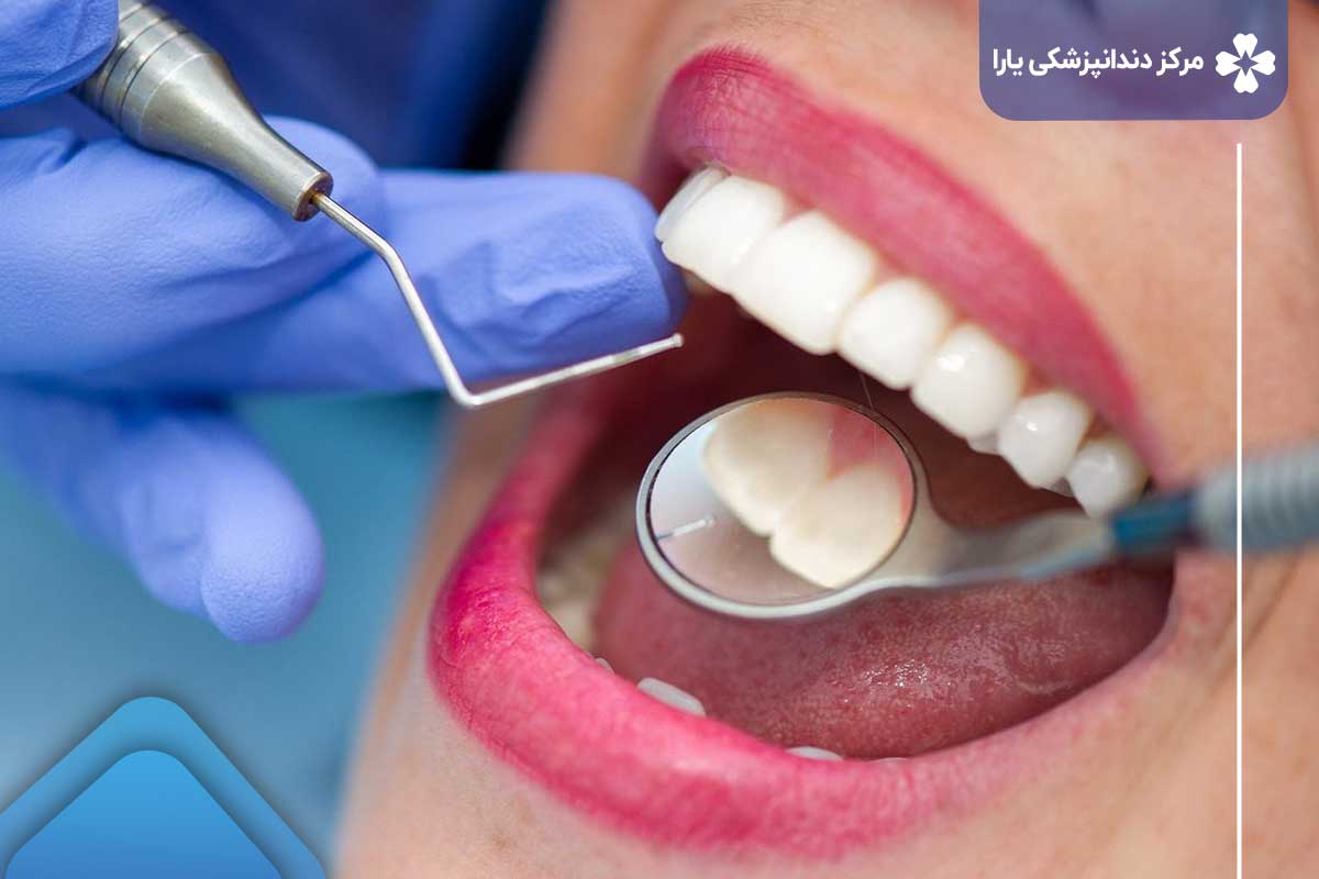 آیا بیمه دندانپزشکی زیبایی را پوشش می‌دهد؟