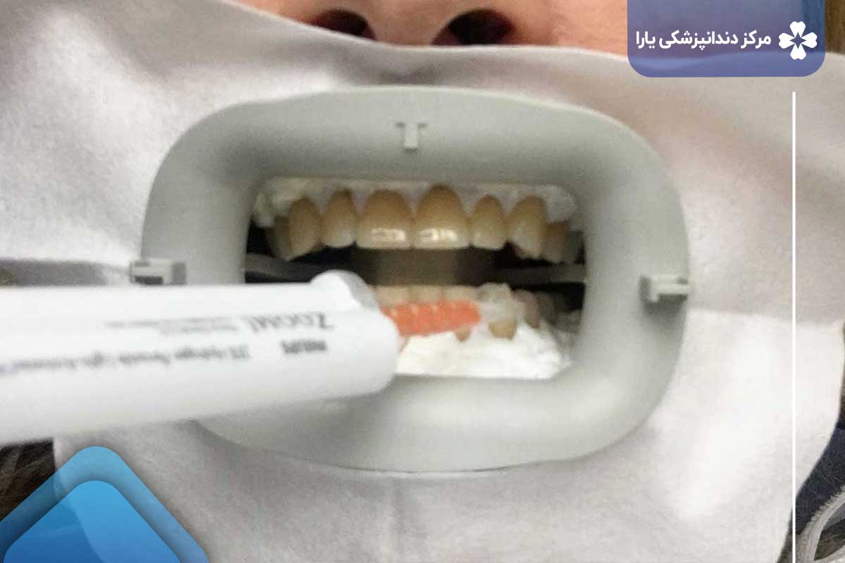 بلیچینگ  دندان در تهرانپارس چقدر طول می‌کشد؟