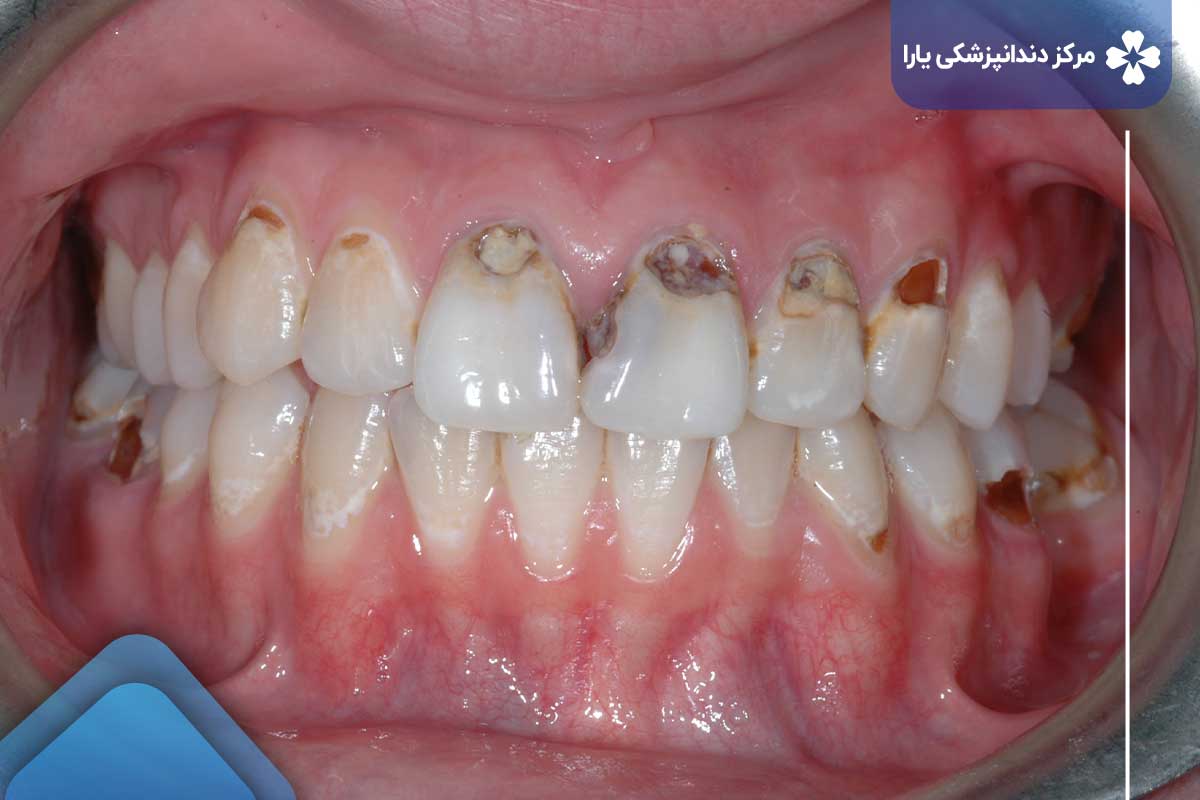 اثرات سیگار روی دندان