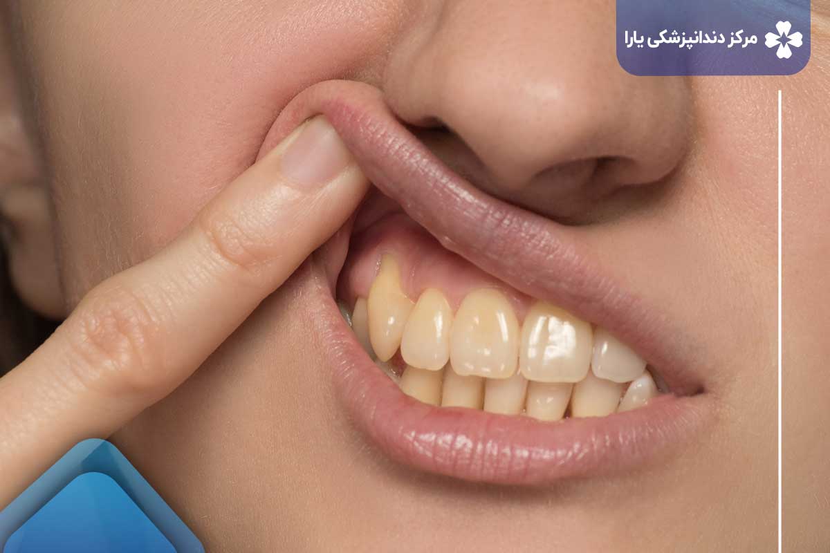 پوسیدگی دندان در اثر تأثیر سیگار بر کامپوزیت دندان