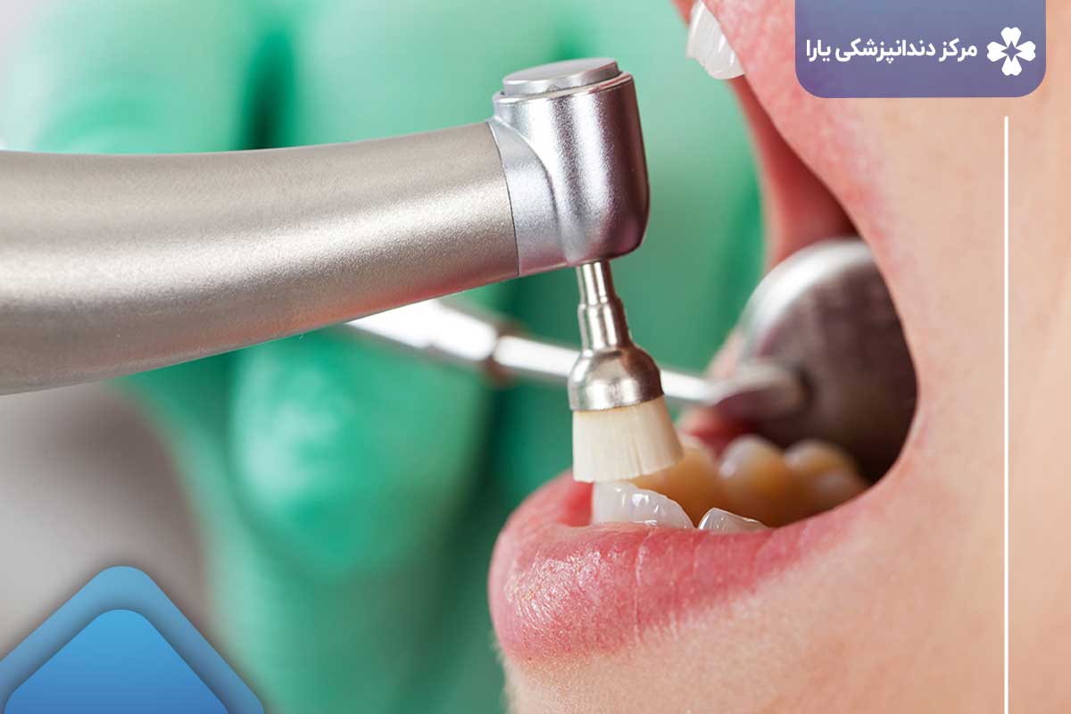 نکاتی برای مدیریت هزینه خدمات دندانپزشکی در تهرانپارس