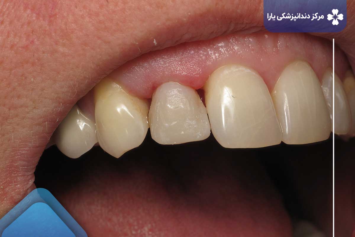 سفید کردن دندان روی همه دندان ها کار نمی کند