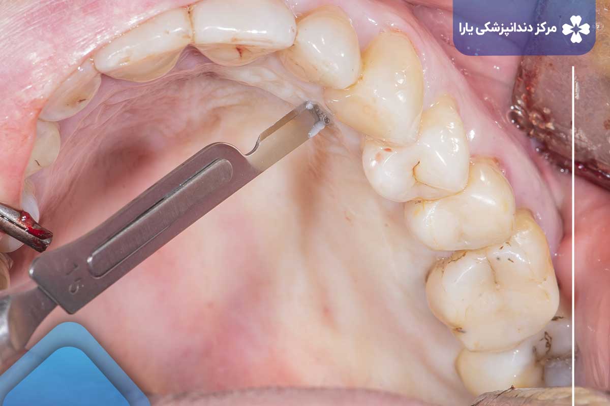 سؤالات متداول مراحل ایمپلنت دندان