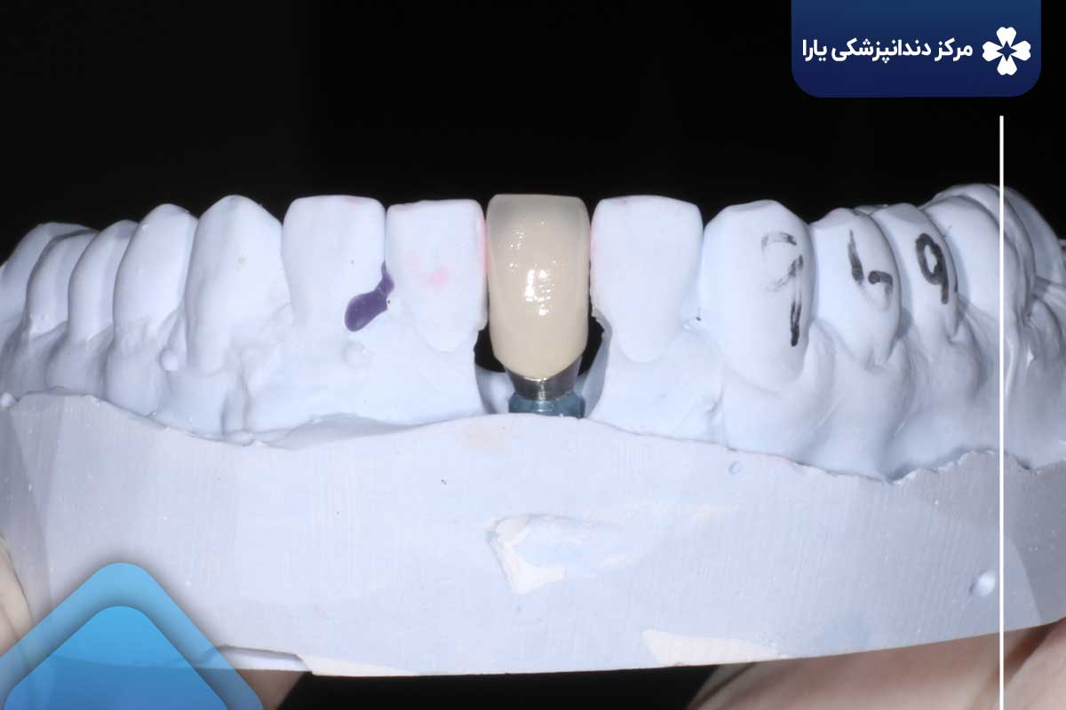 مزایای روکش دندان در دندانپزشکی یارا