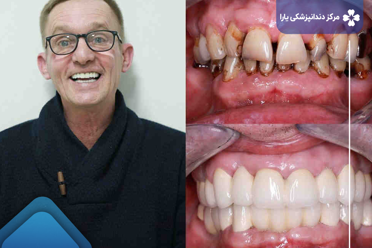 قبل و بعد کاشت دندان