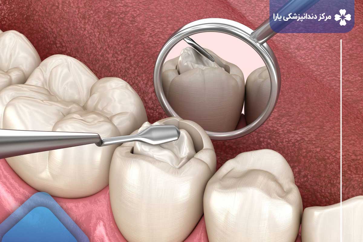 مزایای ترمیم کامپوزیت دندان در تهرانپارس