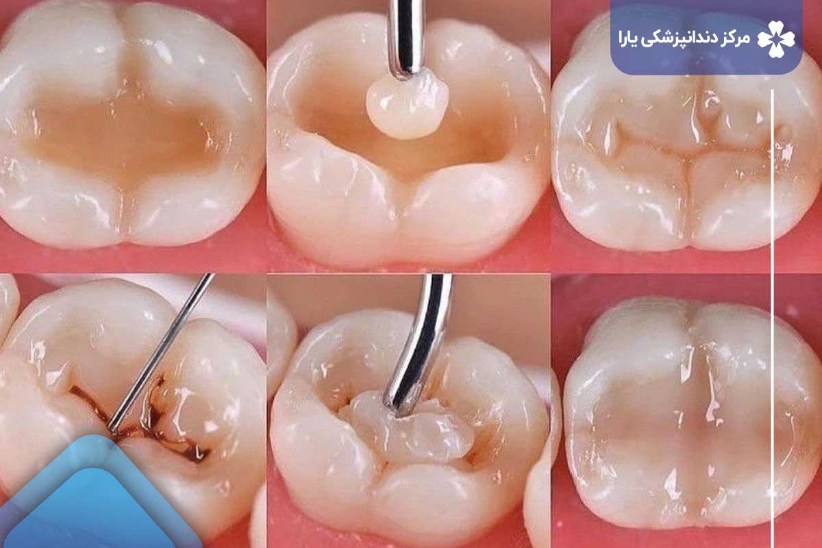 مراحل ترمیم کامپوزیت دندان