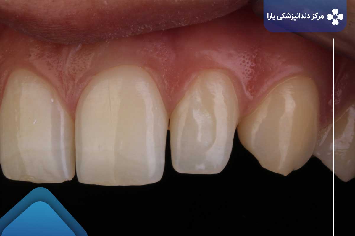 نکات مراقبتی قبل و بعد از ترمیم کامپوزیت دندان