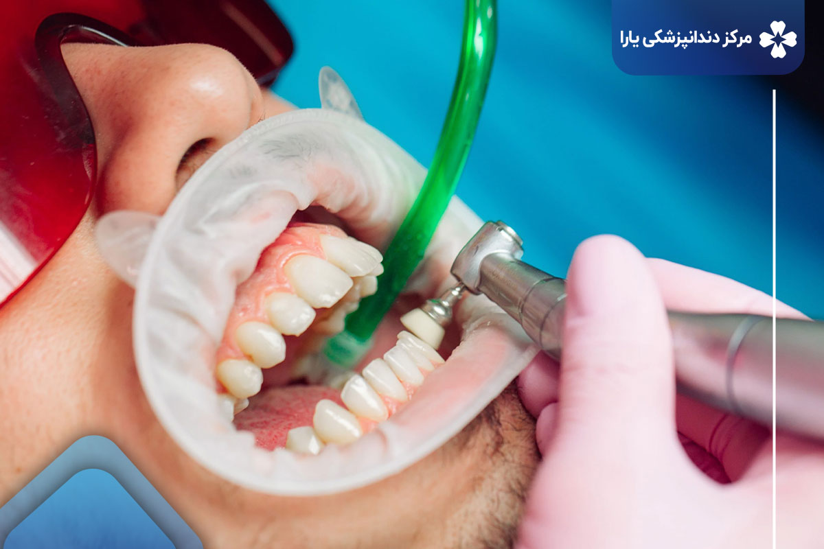  چرا جرم گیری دندان ضروری است؟