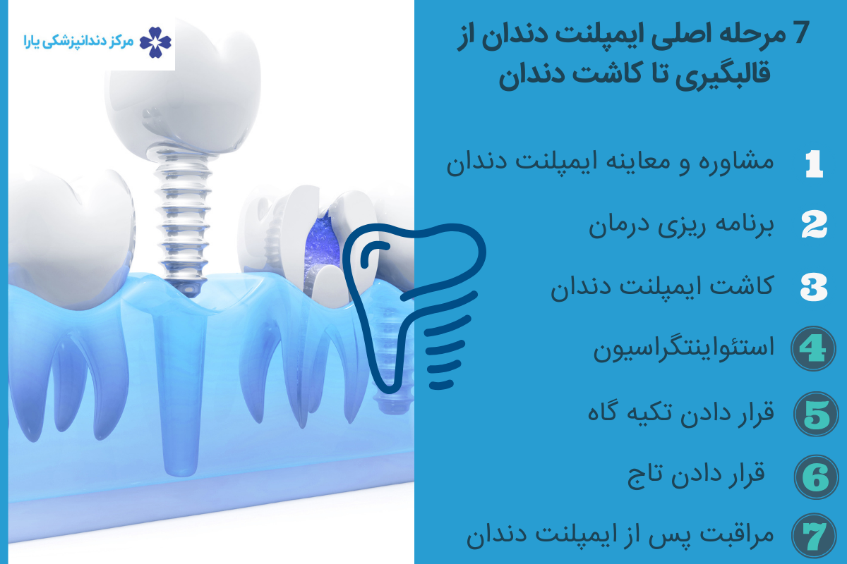7 مرحله اصلی ایمپلنت دندان از قالبگیری تا کاشت دندان