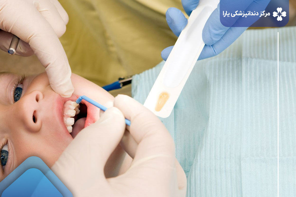 فلورایدتراپی در دندانپزشکی یارا چگونه انجام می‌شود؟