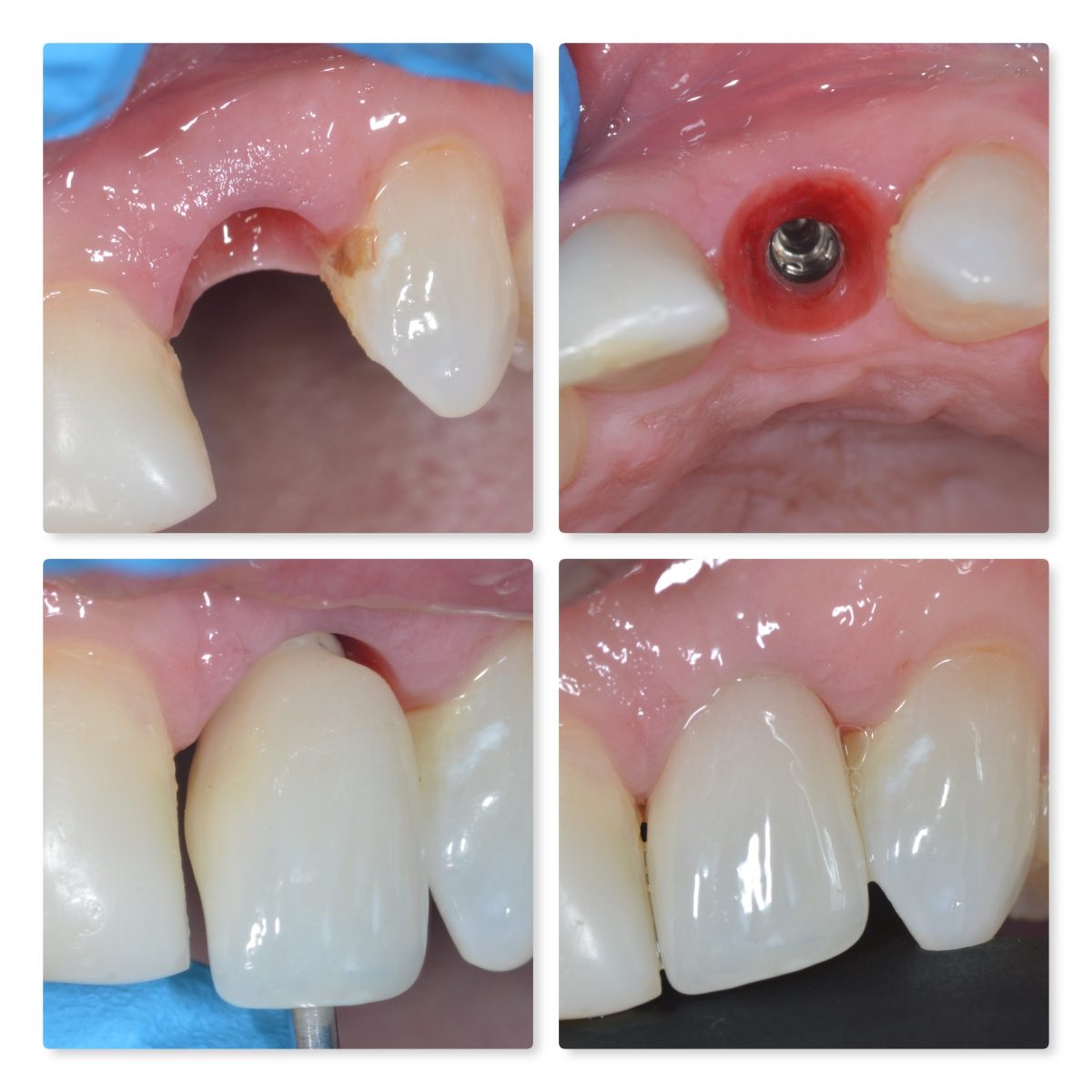ادغام استخوانی سخت ترین مرحله ایمپلنت دندان