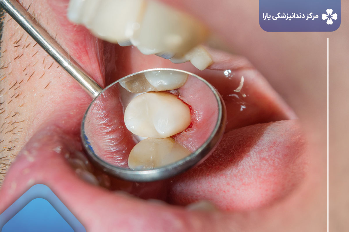 چه کسانی می توانند درمان فیشورسیلانت دندان انجام دهند؟