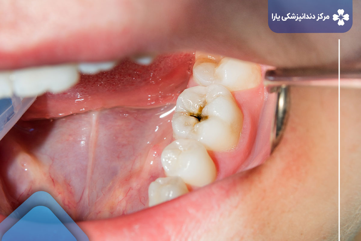 عصب کشی دندان اطفال