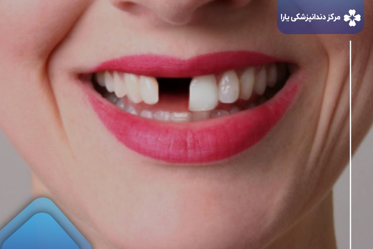 مزایای استفاده از پروتز دندان