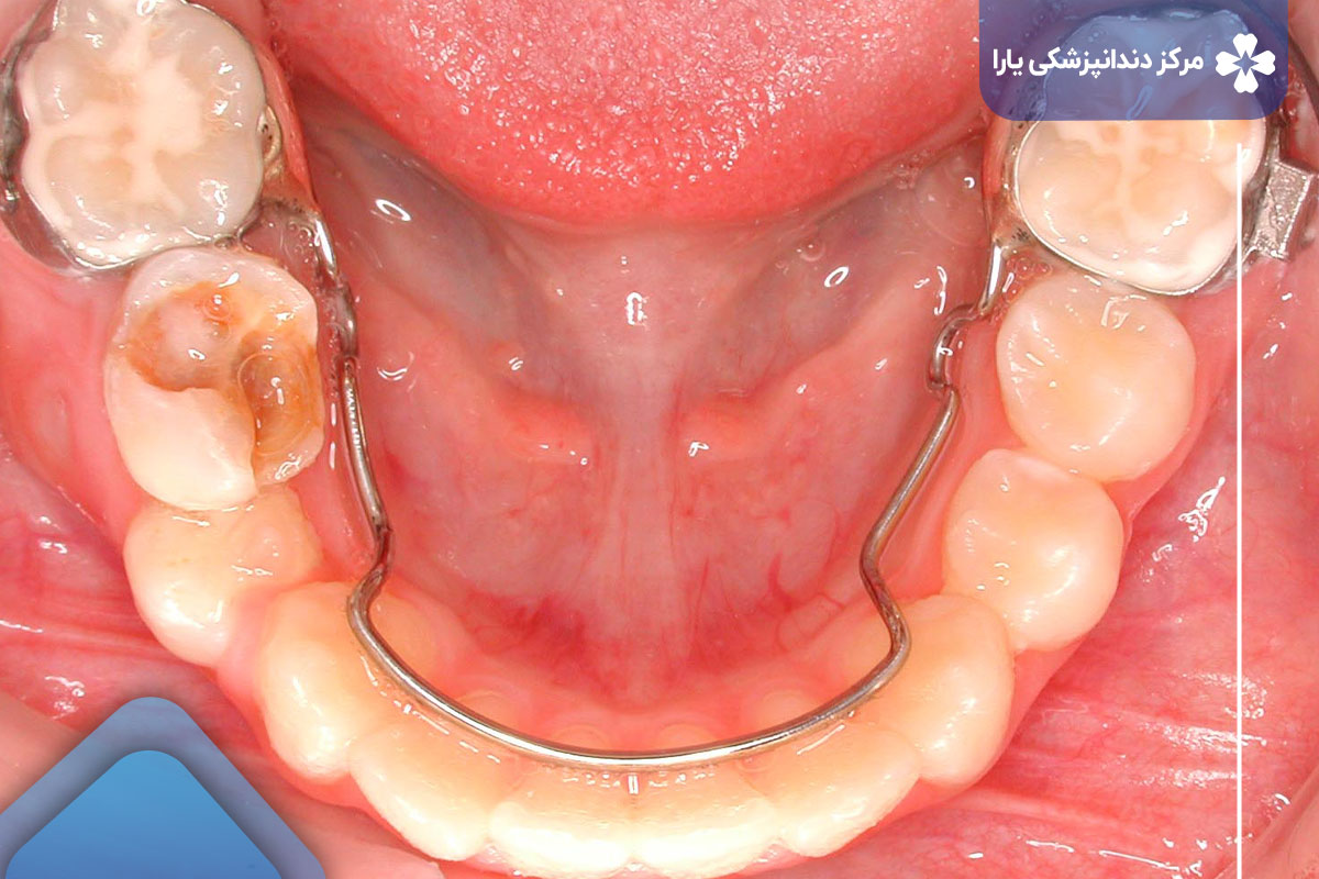 چه کسی به فضا نگهدار دندانپزشکی نیاز دارد