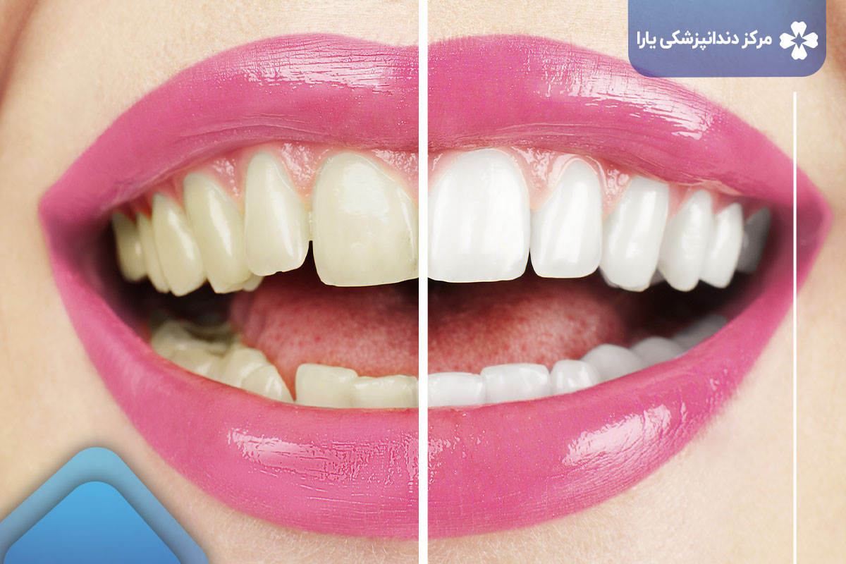 انواع روش‌های درمان در زیبایی دندانپزشکی سفید کردن دندان
