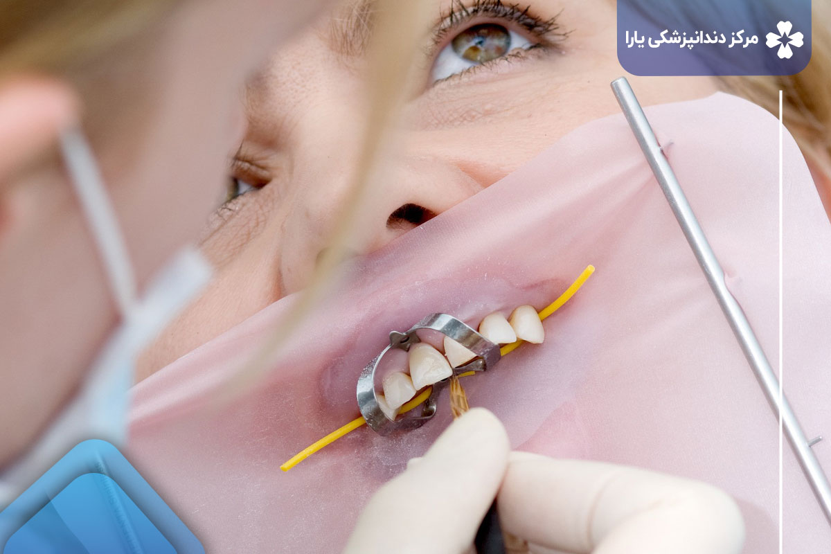 مراقبت پس از درمان دندان‌های عصب کشی شده که لمینت شده‌اند