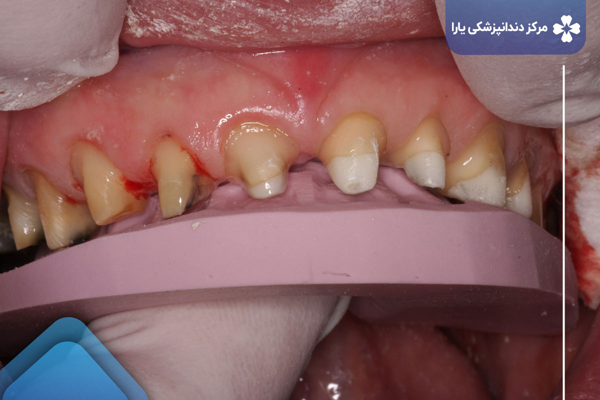 عواملی که باید قبل از انتخاب لمینت دندان در نظر بگیرید