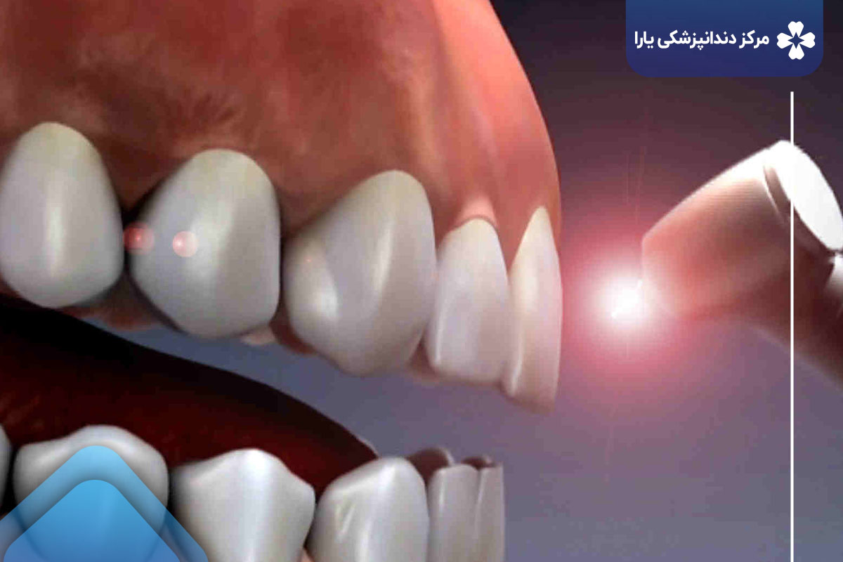 مزایا عصب کشی دندان با لیزر