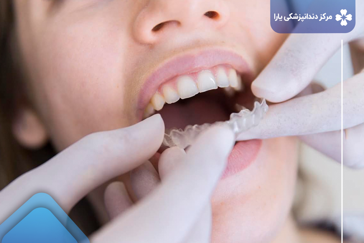 قیمت ارتودنسی دندان در دندانپزشکی یارا