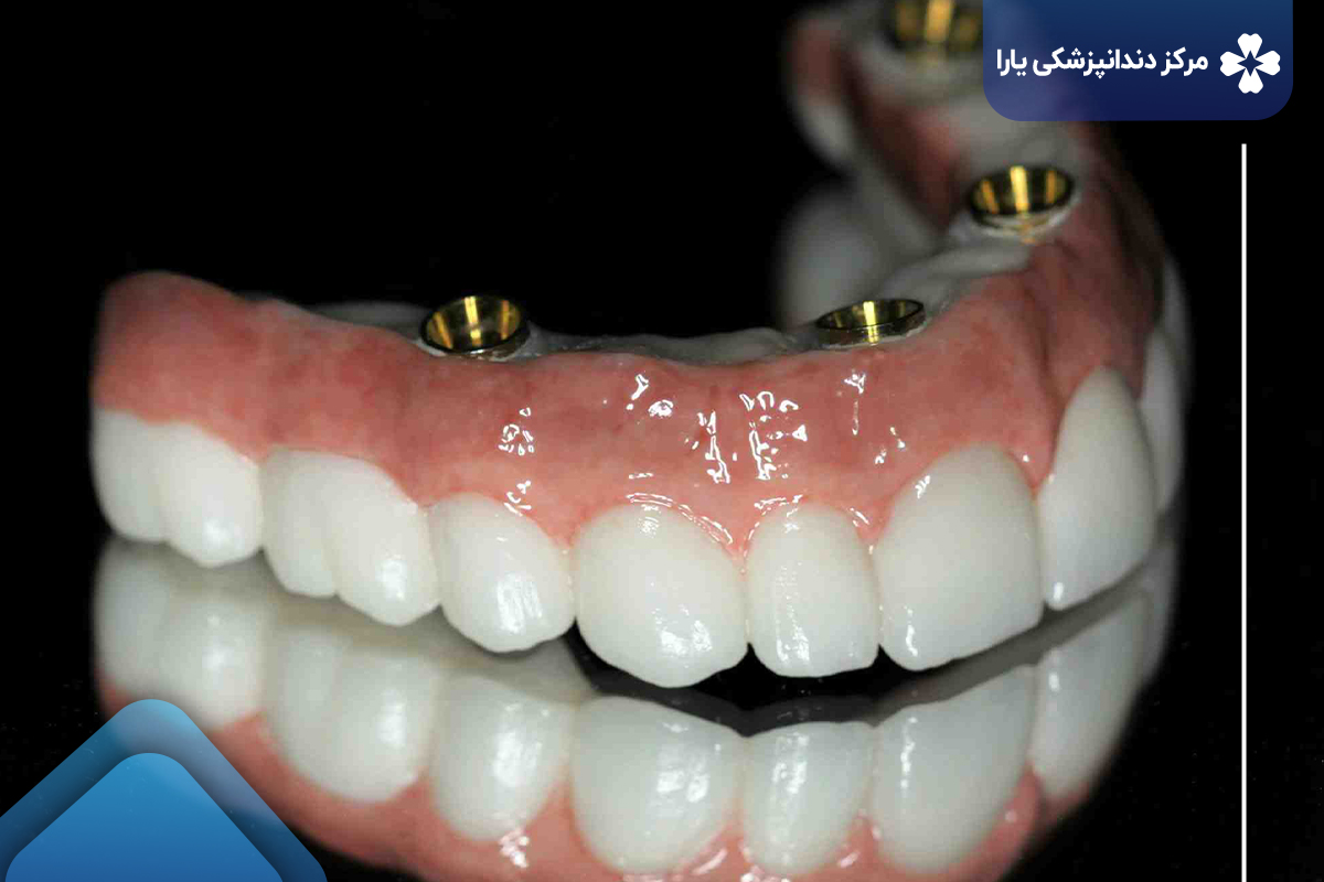 هزینه ایمپلنت دندان در دندانپزشکی یارا