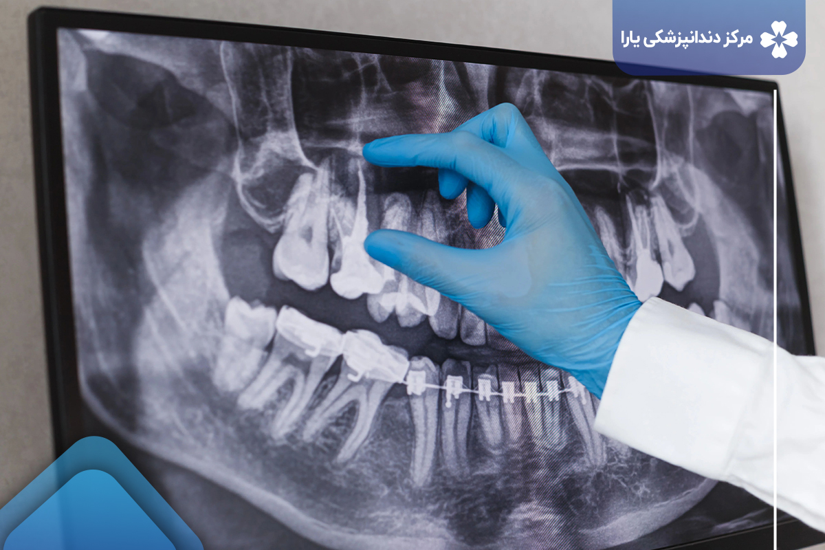 عکس رادیوگرافی عصب کشی دندان در ارتودنسی 