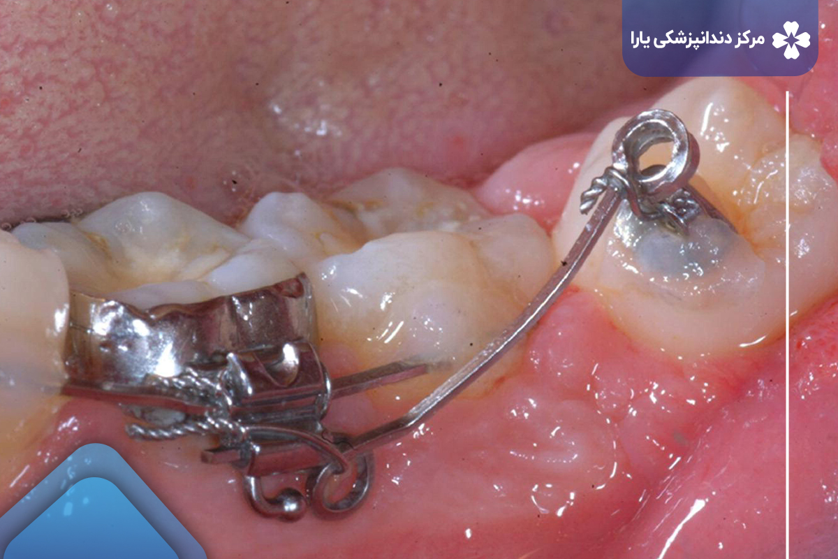 بهبودی و مراقبت‌های پس از درمان عصب کشی دندان در ارتودنسی