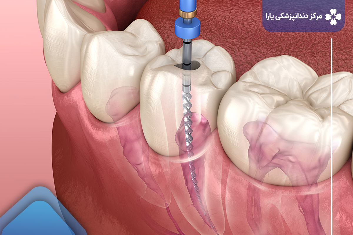 اگر دندان عصب کشی شده درد داشته باشد، آیا مجاز به ارتودنسی این دندان هستیم؟
