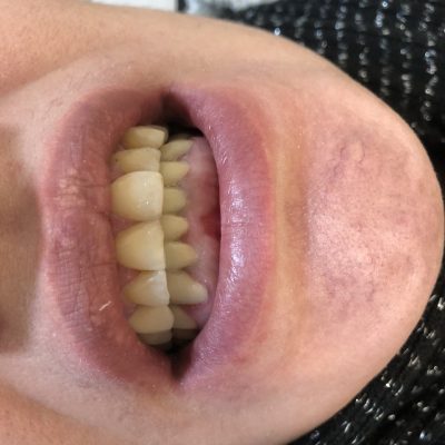 بعد از بریج دندان