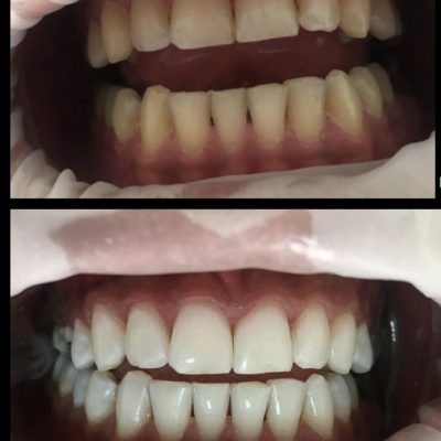 بلیچینگ دندان قبل و بعد
