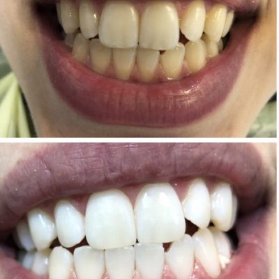 سفید کردن دندان تصویر نمونه درمان