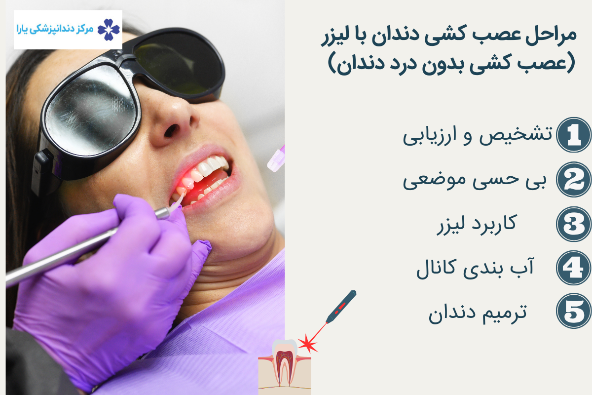 مراحل عصب کشی دندان با لیزر (عصب کشی بدون درد دندان)