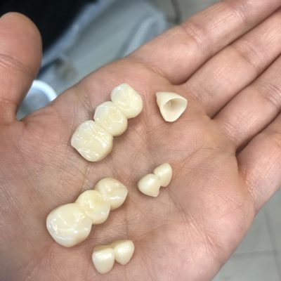 نمونه بریج دندان تمام سرامیکی زیرکونیا