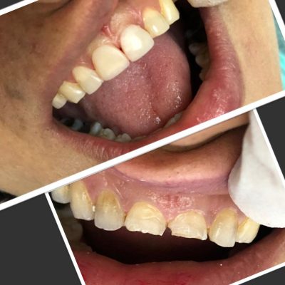 کامپوزیت دندان در دندانپزشکی یارا ( قبل و بعد)