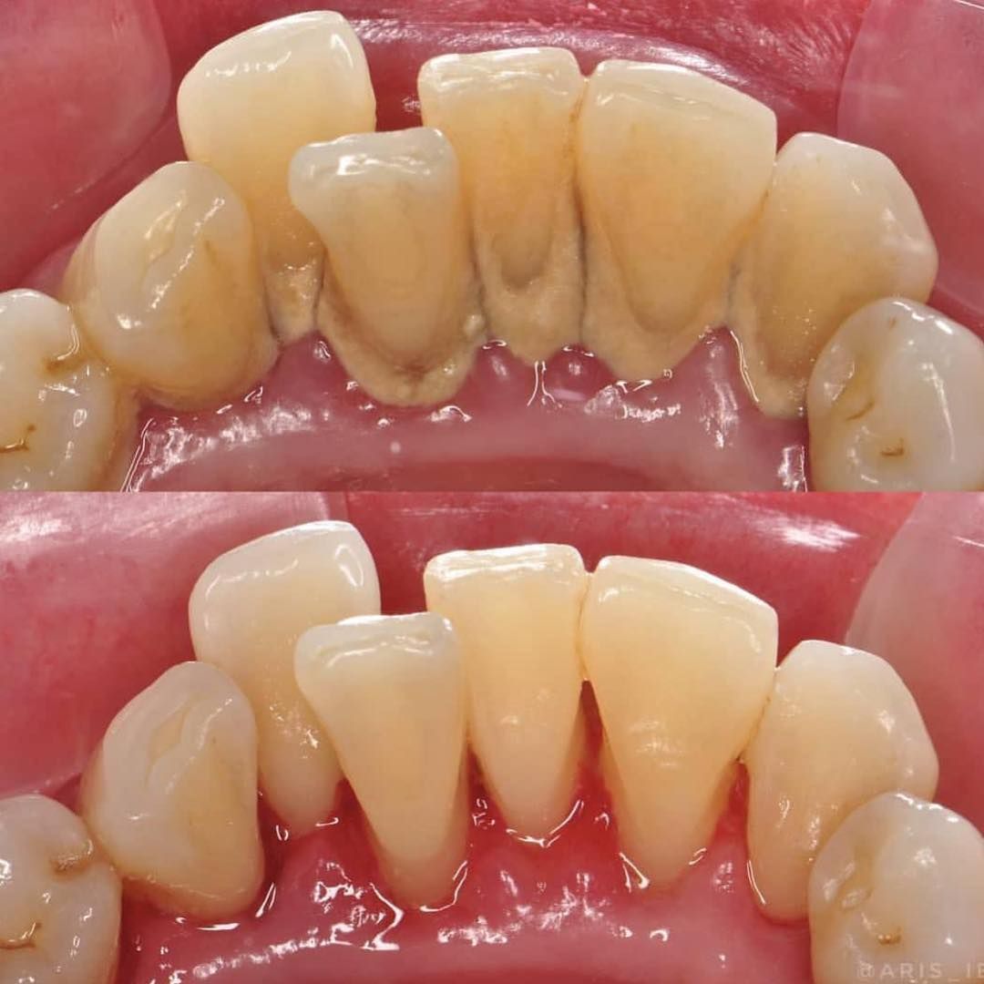 قبل و بعد بروساژ دندان