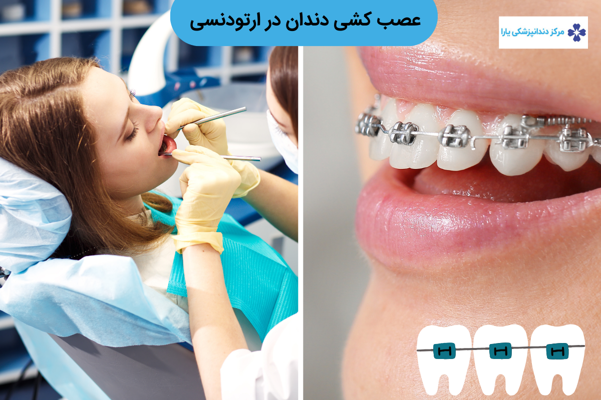 عصب کشی دندان در ارتودنسی