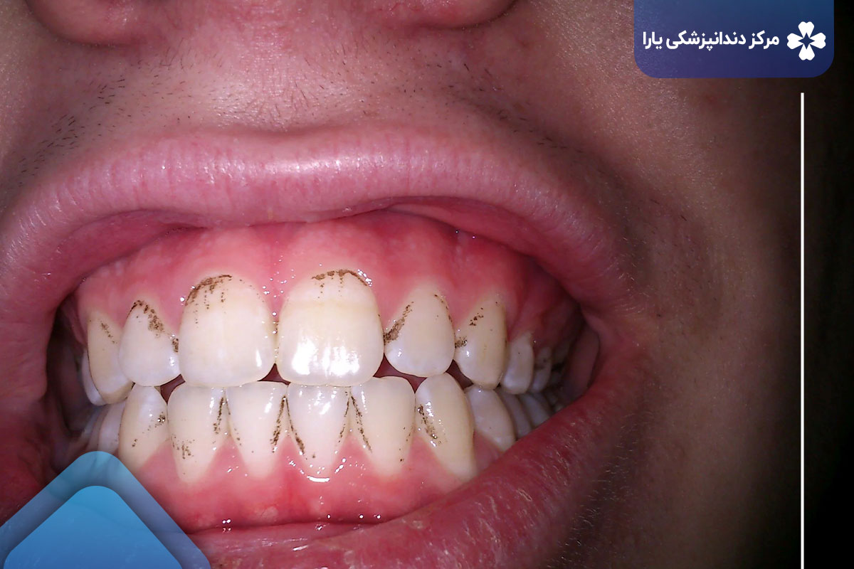 علت سیاه شدن دندان‌ ها چیست؟