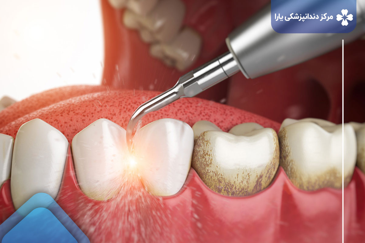 چرا دندانپزشکی یارا را برای جرم گیری دندان در تهران پارس انتخاب کنیم؟