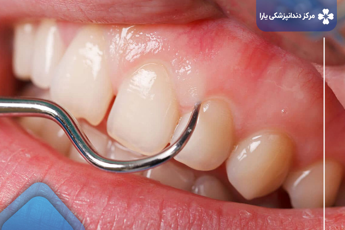 جرم گیری در کلینیک دندانپزشکی تهرانپارس یارا