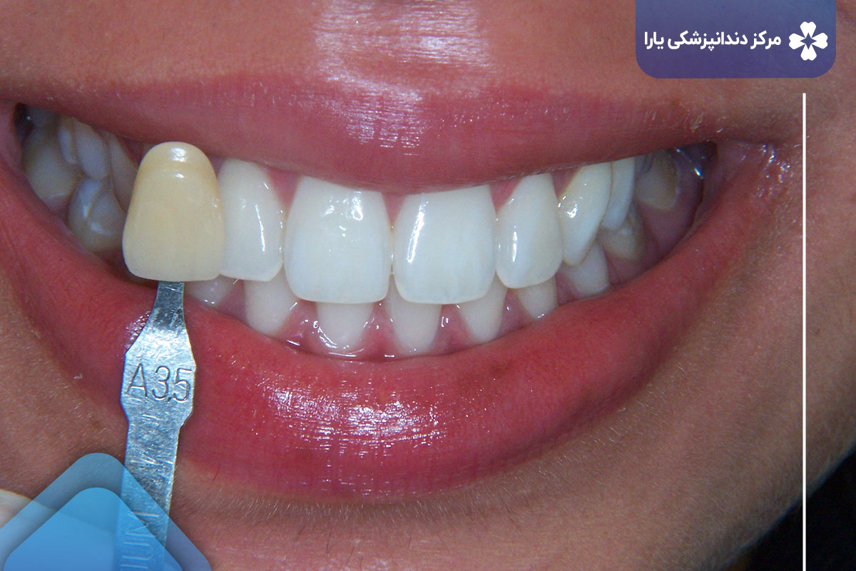 مراحل روش لمینت دندان