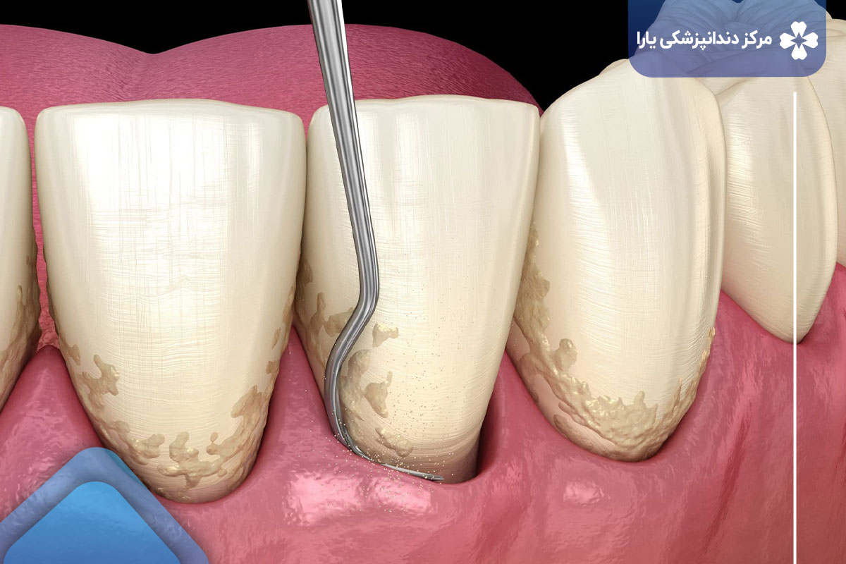 روند درمان بروساژ دندان