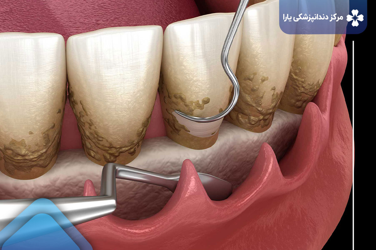 اهمیت بروساژ دندان