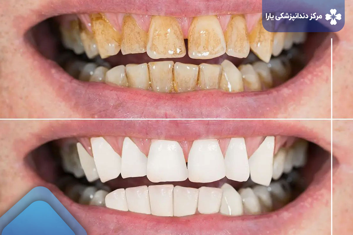 جرم گیری دندان چیست؟