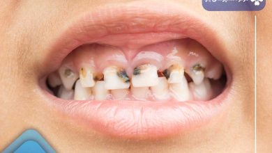 درمان پوسیدگی دندان جلو