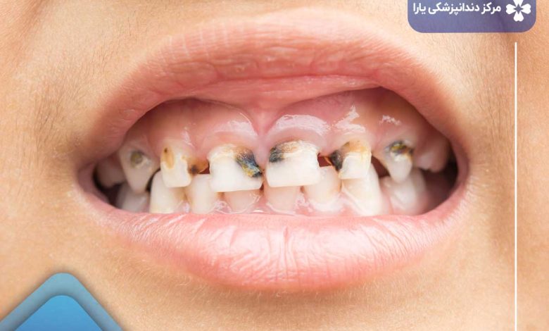 درمان پوسیدگی دندان جلو